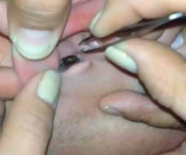 He Claimed That His Right Ear was Painful. What They Extracted From It Will Blow You Away!